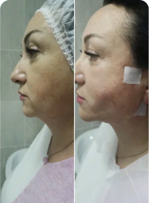 IRIS suture in cannula, middle face Helix barbs dual needle, jaw line