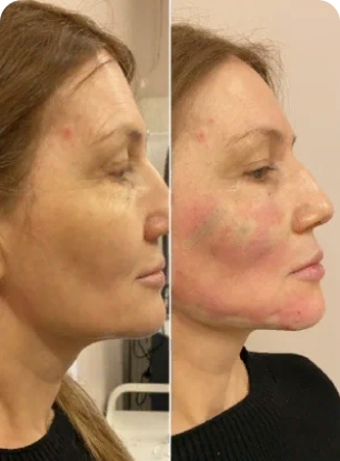 Helix barbs in cannula, middle face and jaw line