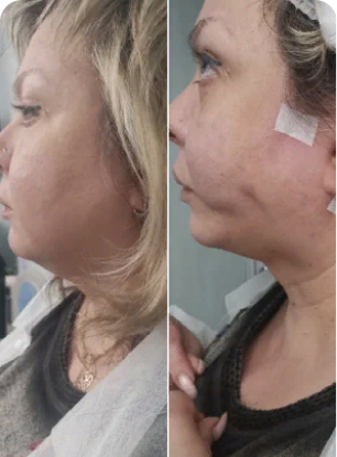 IRIS suture in cannula, middle face, neck and submental